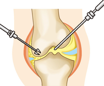 関節鏡視下手術