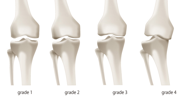 変形性膝関節症の4段階