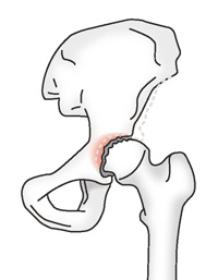 変形性股関節症