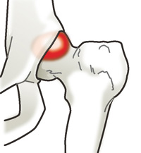 FAI（大腿骨寛骨臼インピンジメント）