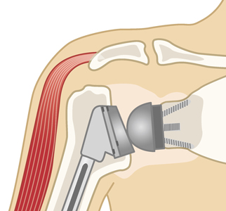 リバース型人工肩関節