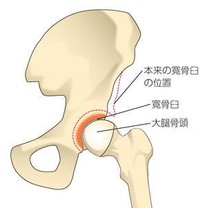 寛骨臼形成不全