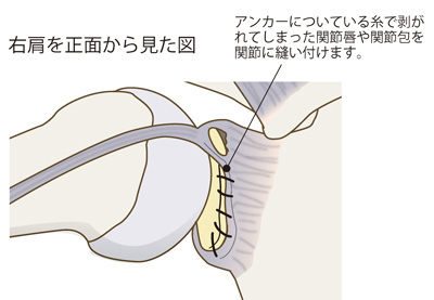 鏡視下バンカート修復術