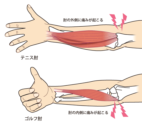 テニス肘、ゴルフ肘