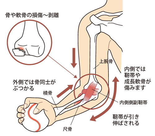 野球肘