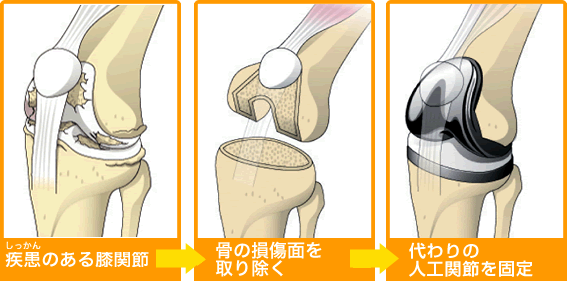 人工ひざ関節置換術とは
