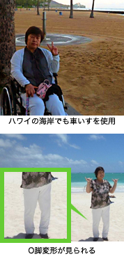 ハワイの海岸でも車椅子を使用・Ｏ客変形が見られる