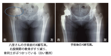 八里さんの手術前後のＸ線写真