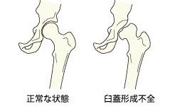 正常な状態・臼蓋形成不全