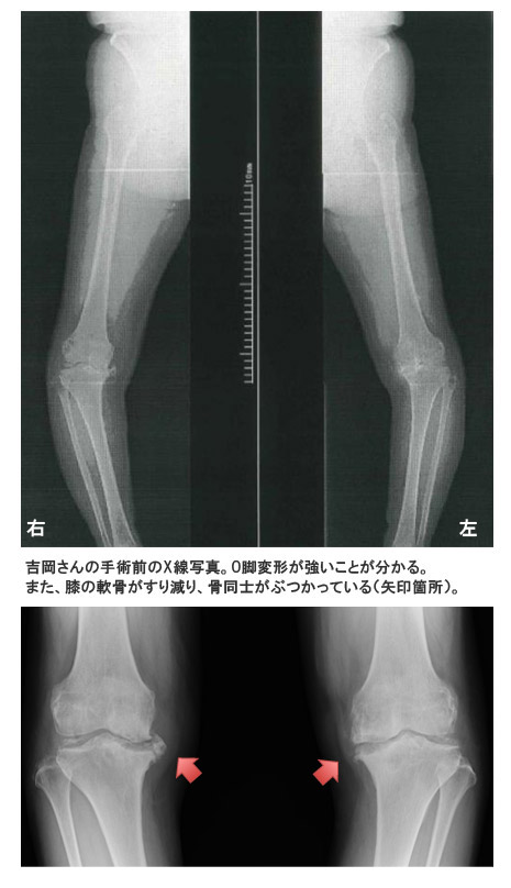 吉岡さんの手術前のＸ線写真