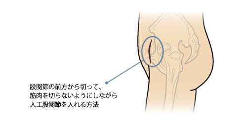 股関節の前方から切って、筋肉を切らないようにしながら人工股関節を入れる方法