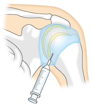 肩関節へのステロイド注射