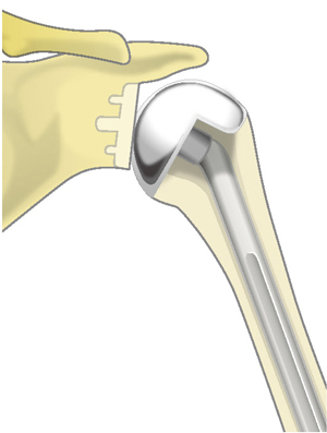 従来の人工肩関節置換術